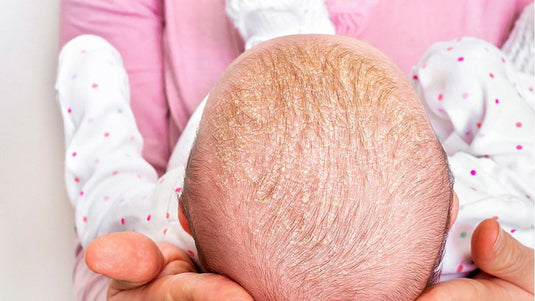 costra-lactea-cabeza-cuerpo-bebes-sintomas-causas-tratamiento